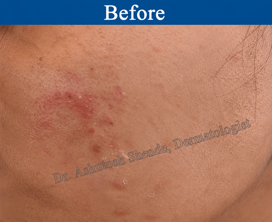  Acne with Inflammation before