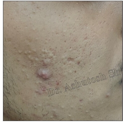  Cystic Acne before