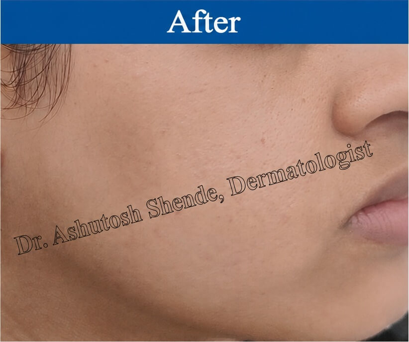 Pimple After