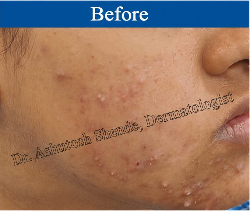 Pimple Before